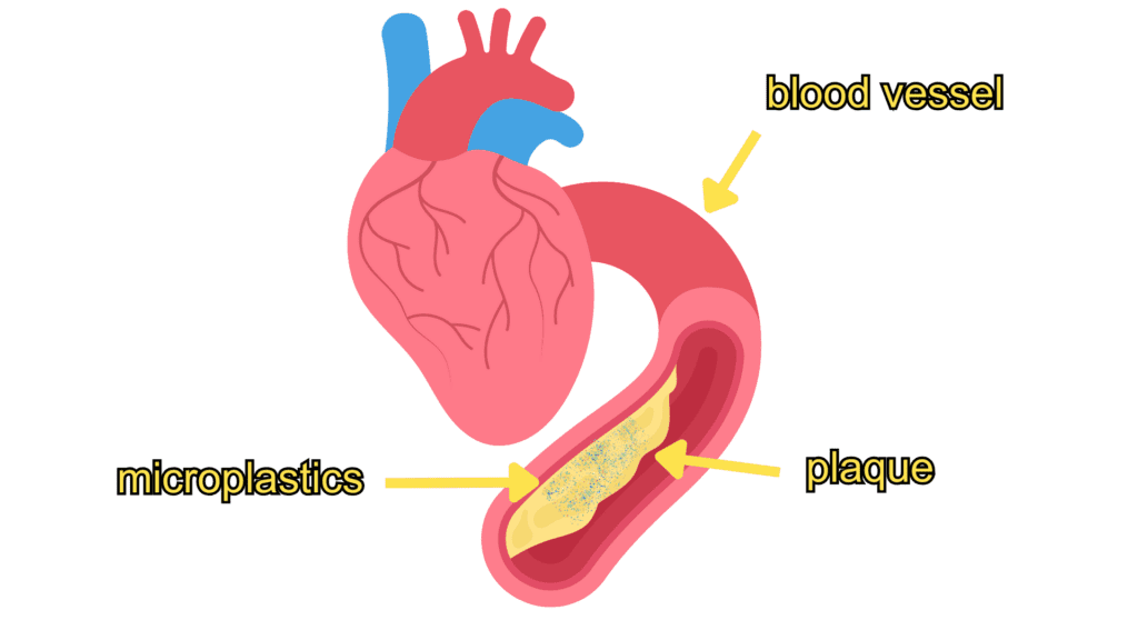 illustration of blood vessel, plaque, and microplastics