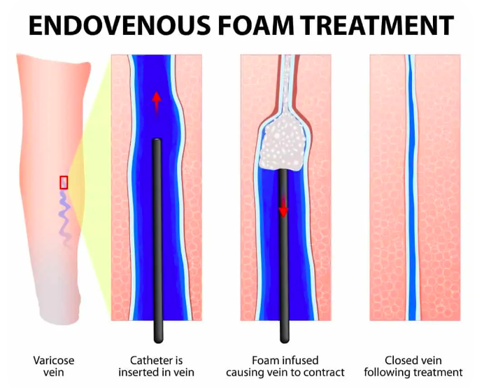 varithena foam treatment explanation