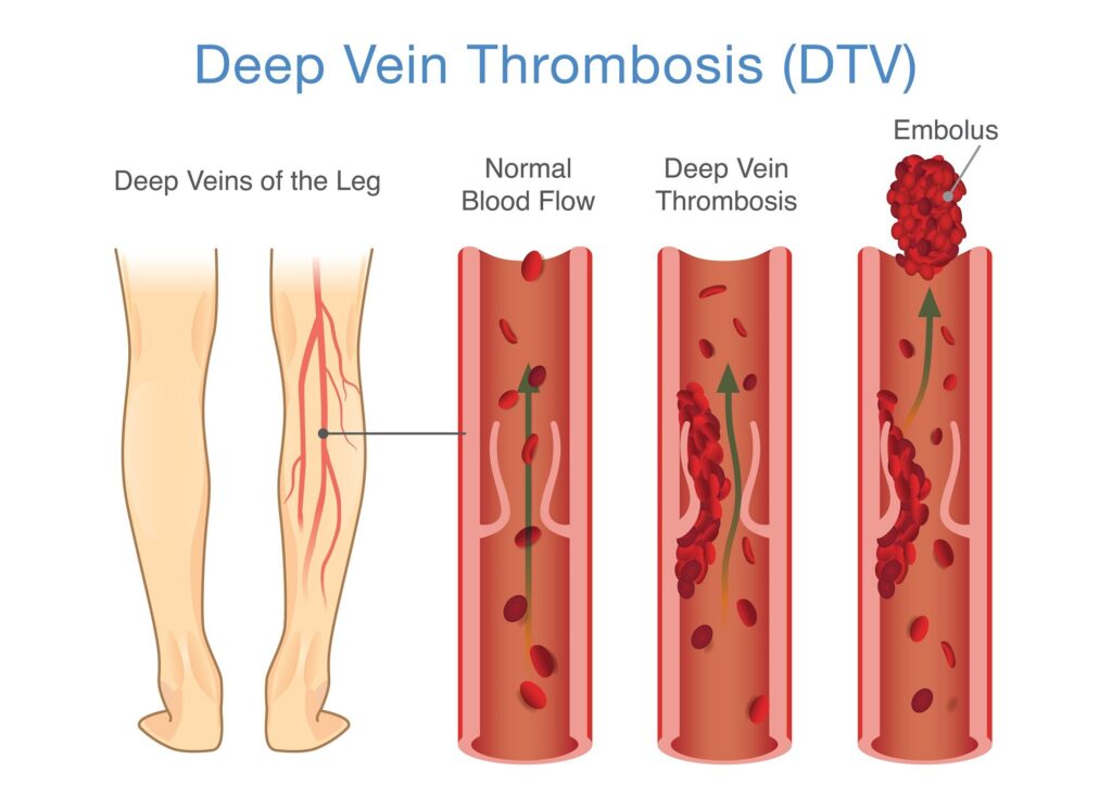 DVT infographic