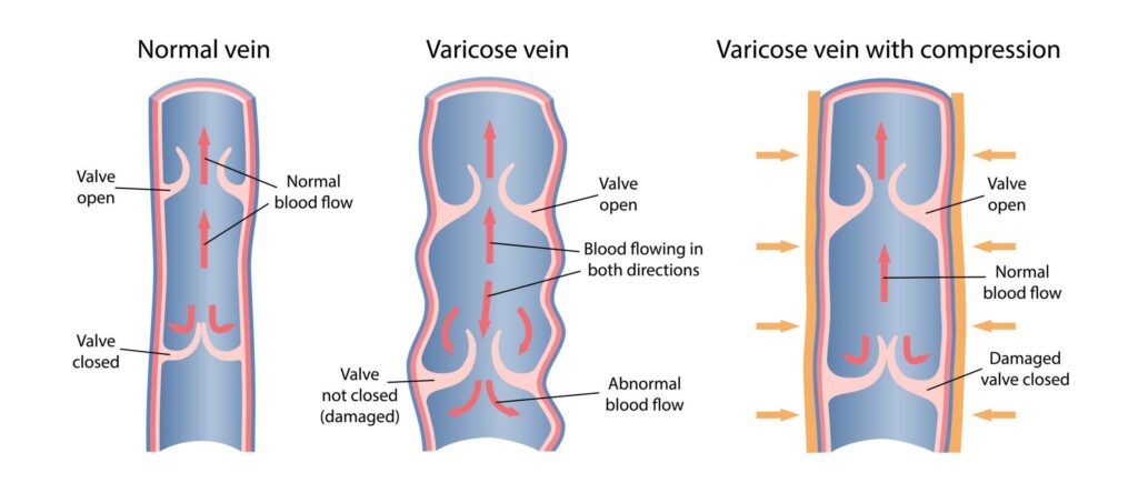 normal vein vs varicose vein vs varicose vein with compression