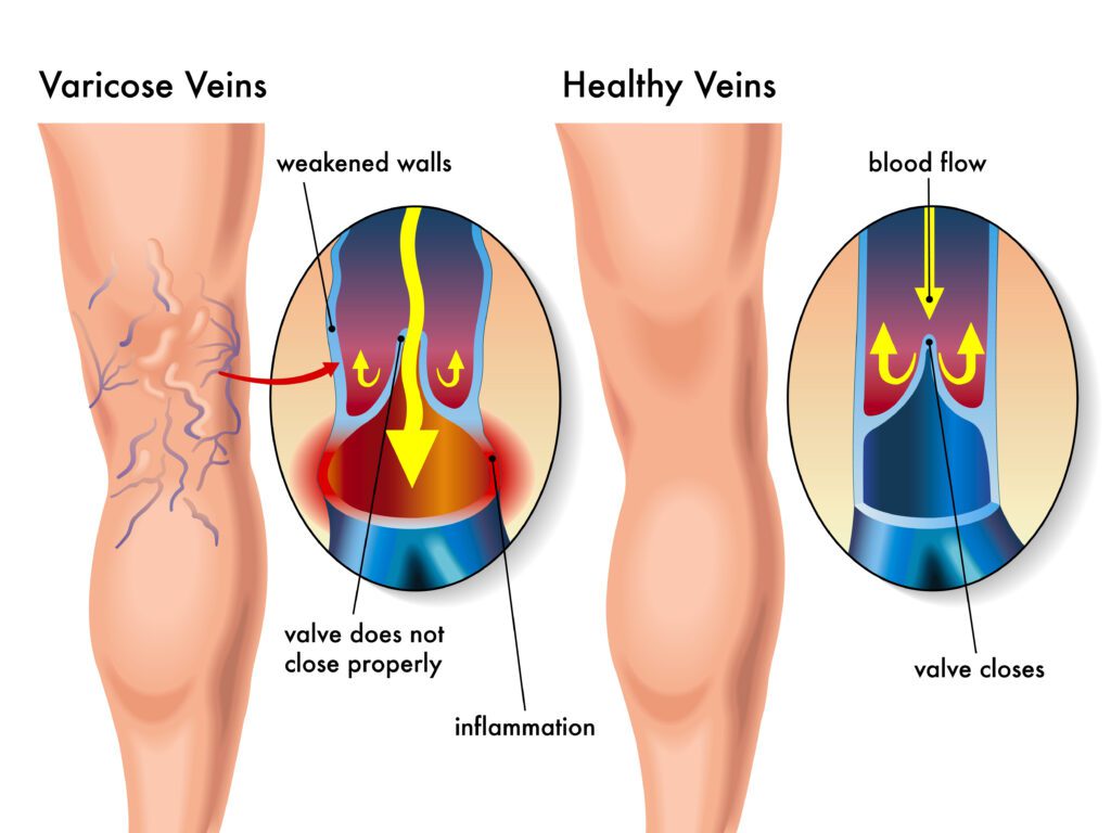 varicose veins vs healthy veins infographic