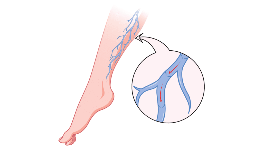 varicose veins