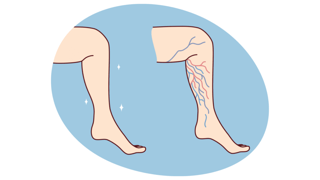 varicose veins